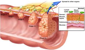 storia naturale tumore colon 2