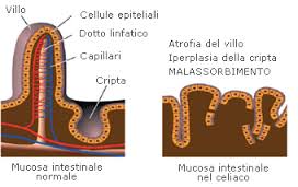 celiachia